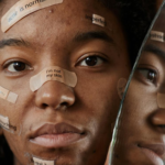 ¿Qué problemas de salud puede crear el acné?